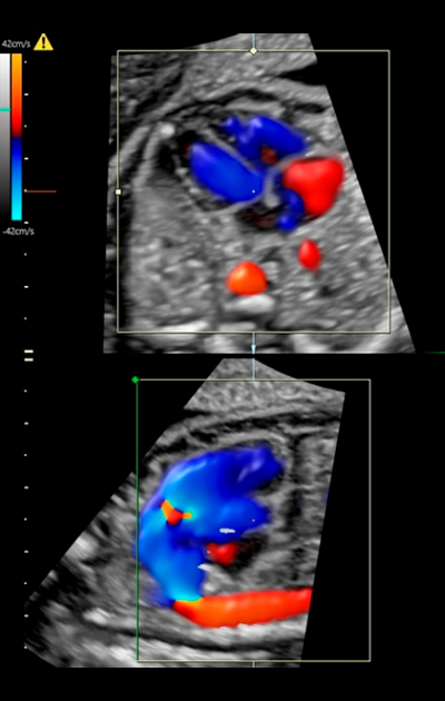 Ecocardiografia Fetal